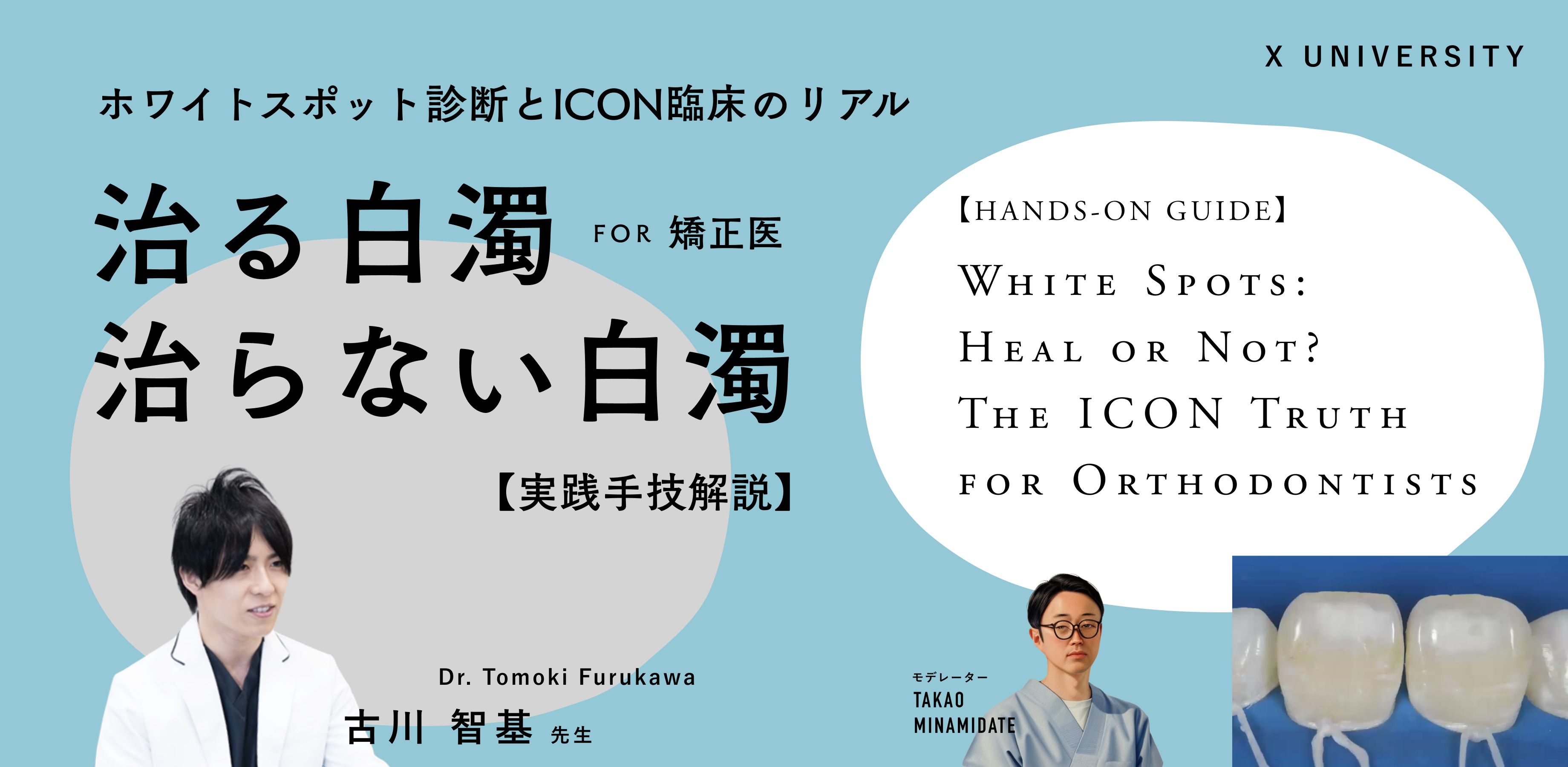治る白濁、治らない白濁。ホワイトスポット診断とICON臨床のリアル。講師 古川智基先生、モデレーター 南舘崇夫。